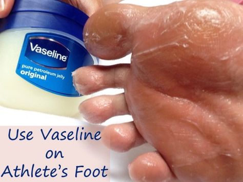 Vaseline for Athlete's Foot Benefits Of Vaseline, Winter Beauty Tips, Vaseline Uses, Vaseline Beauty Tips, Skin Hand, Athletes Foot, Petroleum Jelly, Beauty Tips For Skin, Skin Remedies