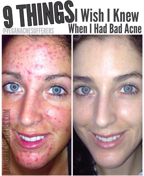 9 Things I Wish I Knew When I Had Bad Acne - Banish Face Breaking Out, Teenage Acne, Haut Routine, Forehead Acne, Pimples Under The Skin, Acne Overnight, Bad Acne, Natural Acne, Cystic Acne