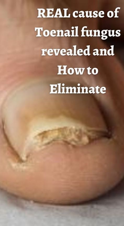 Toenail Health, Toenail Fungal Infection, Toenail Fungus Remedies, Nail Infection, Fungal Nail, Ingrown Toe Nail, Toenail Fungus, Fungal Infection, Nail Fungus