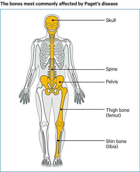 Paget's disease of bone Pagets Disease, Complementary Medicine, Calcium Supplements, Bone Diseases, Genetic Testing, Blood Test, Bone Health, Disease, Bones