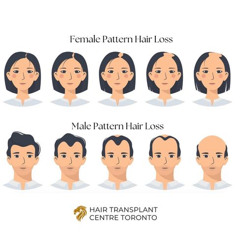 August is Hair Loss Awareness Month! Here is a depiction of female pattern hair loss vs male pattern hair loss. Female pattern hair loss generally manifests as diffuse thinning across the entire scalp, with hair gradually becoming finer and less dense, often starting at the part and spreading outward. In contrast, male pattern hair loss typically begins with a receding hairline at the temples and the development of a bald spot at the crown, eventually leading to a more pronounced bald area.... Female Pattern Baldness, Pattern Hair, Receding Hairline, Bald Spot, Female Hair, Bald Women, Trendy Hair Color, Boho Hairstyles, Hair Inspiration