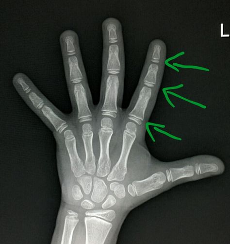 #Normal #hand #xray used to evaluate the #child's #bone #age by assessing the #growth #plates. #radiologist #radiology Medical Radiography, Chuck Missler, Nephilim Giants, Radiology Technician, Xray Technician, Genesis 6, Xray Tech, Dipper Pines, Genetic Disorders