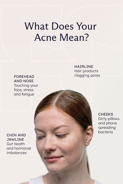 Bumps On Face, Acne Types, Clear Skin Routine, Skin Advice, Acne Skincare, Types Of Acne, Get Rid Of Blackheads, Acne Breakout, Acne Care