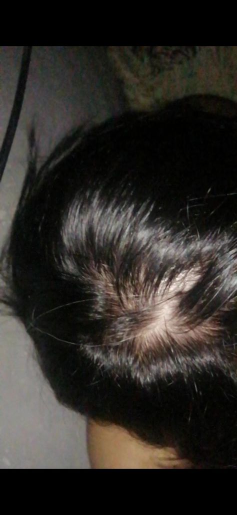 I'm 18 yo is this a bald spot or cowlick? Cowlick Hair, Bald Spots Women, Celebrity Hair Colors, Bald Spot, Women Makeup, Hair And Beauty, Cute Style, Celebrity Hairstyles, Style Women