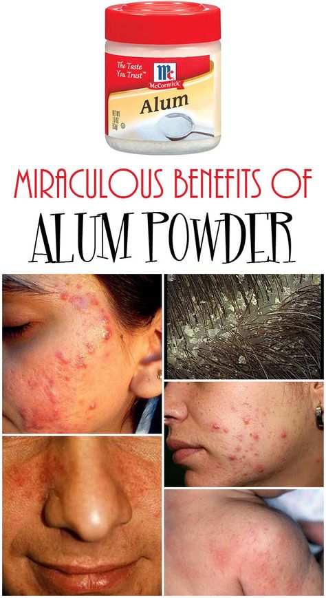 Alum Powder, Rid Of Dandruff, Chest Acne, Forehead Acne, Back Acne Treatment, Hair Removal Diy, Getting Rid Of Dandruff, Underarm Hair Removal, Remove Hair