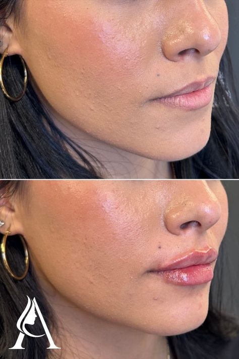 Lips before and after - we're OBSESSED with this first-time lip filler transformation!

Restylane Kysse lip filler in Philadelphia, PA. 

Book a consultation with our amazing injectors at Ari Blanc Medical Spa for your own lip makeover! Filler Transformation, 1ml Lip Filler, Dermal Fillers Lips, Lip Flip, Lips Inspiration, Botox Lips, Facial Fillers, Thin Lips, Small Lips