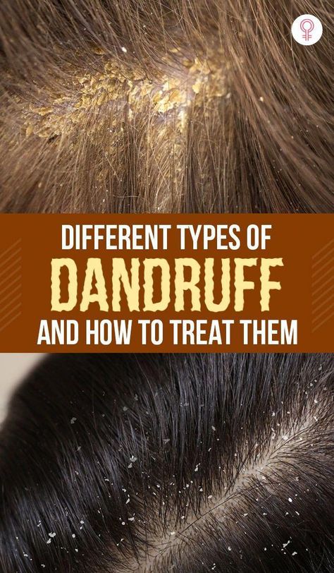 There are different types of dandruff. To effectively treat it and prevent future flakes, we Oils For Dandruff, Dandruff Remedy, Getting Rid Of Dandruff, How To Grow Your Hair Faster, Natural Acne Remedies, Baking Soda Shampoo, Flexible Dieting, How To Grow Nails, Hair Control