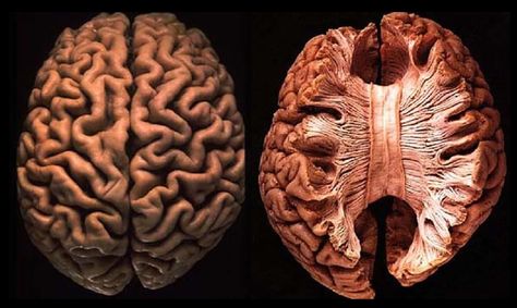 Dissected Brain Corpus Callosum Corpus Callosum, Anatomy Study, Weird Dreams, Medical Illustration, Human Brain, Mad Scientist, Anatomy Art, Human Anatomy, Neuroscience