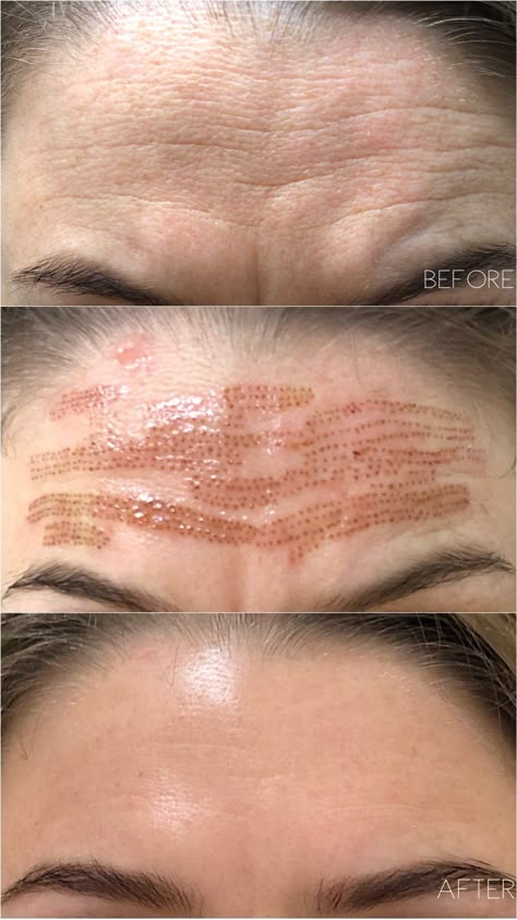 Fibroblast Skin Tightening — AskCares Skin Tightening Procedures, Tighten Facial Skin, Plasma Pen, Face Lift Surgery, Skin Tightening Treatments, Facial Fillers, Facial Contouring, Facial Aesthetics, Injectables Fillers