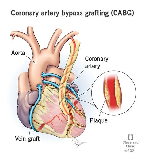 Coronary Bypass Surgery: Purpose, Procedure and Recovery Quadruple Bypass Heart Surgery, Coronary Bypass Surgery Heart, Cardiothoracic Surgery, Calcium Channel Blockers, Medical Notes, Heart Doctor, Vein Removal, Chest Discomfort, Coronary Artery