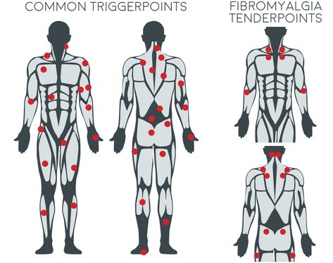 Trigger Point Release, Trigger Point Massage, Cupping Massage, Massage Therapy Techniques, Muscle Massage, Trigger Point Therapy, Therapy Techniques, Cupping Therapy, Neck Massager