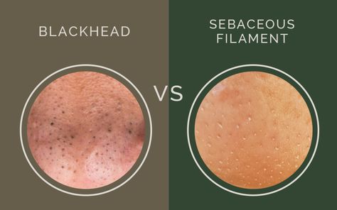 blackhead versus sebaceous filament, what's the difference? congestion / clogged pores / Clogged Pores On Nose, Blackheads On Cheeks, What Are Blackheads, Sebaceous Filaments, Nose Pores, Blackheads On Nose, Mole Removal, Natural Skin Care Remedies, Rid Of Blackheads