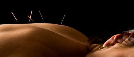 When it comes to endometriosis, many acupuncturists work to “help your body to heal itself.” Acupuncture Fertility, Point Acupuncture, Dry Needling, Endocannabinoid System, Hot Flashes, Traditional Chinese Medicine, Acupressure, Chinese Medicine, Chiropractic