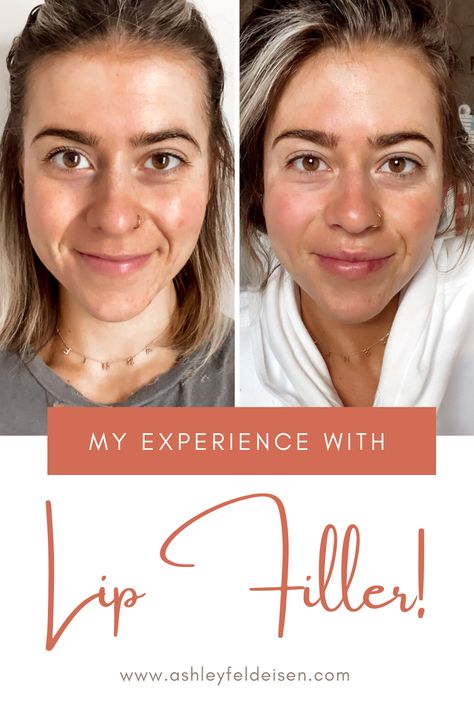 A full look into an experience with lip filler. The process, healing and progress broken down! Lip Fillers Bruising, Lip Filler Healing Stages, Lip Filler, Lip Fillers, Full Look, Healing Process, The Process, Lips, Healing