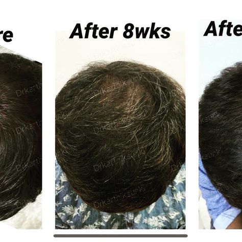 Bluewaters Spa and Sculpt is now offering PRP! Here is a client who got wonderful results with PRP Therapy. We can see good results for hair problem if addressed in the early stages. With early intervention, PRP therapy can achieve these results. Call for your free consultation today! 321-313-6015 #happyclient #happyclientshappyme #prphairrestoration #prptreatment #preventhairloss #preventbalding #skinhealthexpert #skinhealthblogger #skinspecialist Prp Therapy, Hair Problem, Prp Hair, Health Blogger, Skin Specialist, Early Intervention, Hair Problems, Free Consultation, Skin Health