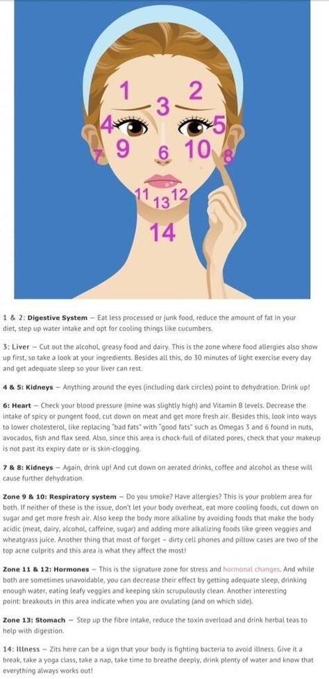 What your pimples tell you. Not sure how accurate this is but taking the advice is worth a shot! Doterra Acne, Gesicht Mapping, Face Mapping Acne, Face Mapping, Acne Causes, Acne Problem, Face Acne, Acne Remedies, How To Get Rid Of Acne