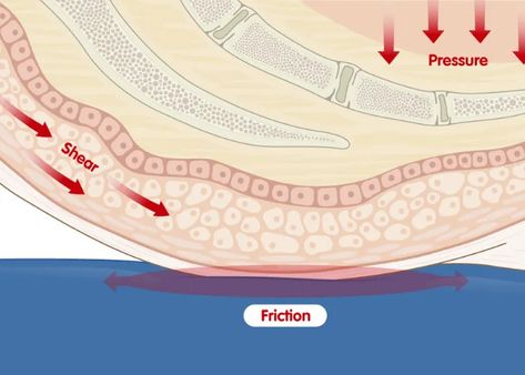 How Friction and Shear Cause Pressure Ulcers - Gel Ovations Force And Pressure, Shear Force, Pressure Ulcer, Wound Care, Quick Saves