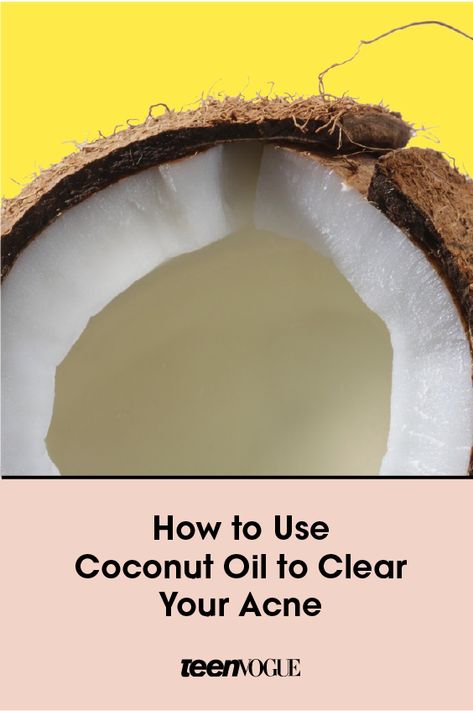 Clearing acne with coconut oil might not make a ton of sense logically, but it's actually a pretty effective tool. Here's how to use it to clear up zits. Coconut Oil Remedies, Clearing Acne, Acne Beauty, Clear Your Skin, Coconut Oil For Acne, Best Acne Products, Home Remedies For Acne, Cystic Acne, Things Under A Microscope