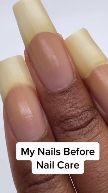 Nail Growth Tips, Grow Nails Faster, Glass Nail File, Nail Care Tips, Nail Oil, Brittle Nails, Ingrown Toe Nail, Striped Nails, Nail Growth