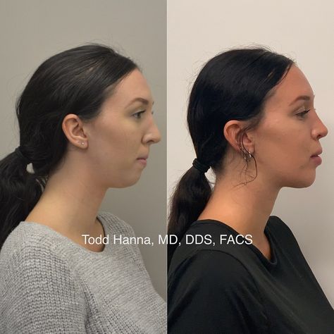 Dr. Todd Hanna, MD, DDS, FACS on Instagram: “This is a complex case with 2 main problems.. 1. She was treated with a chin implant elsewhere when she really needed orthognathic surgery…” Chin Implant Before And After Women, Orthognathic Surgery Before And After, Chin Implant Before And After, Double Chin Surgery, Chin Surgery, Jaw Reduction Surgery, V Line Surgery, Orthognathic Surgery, Plastic Surgery Fail