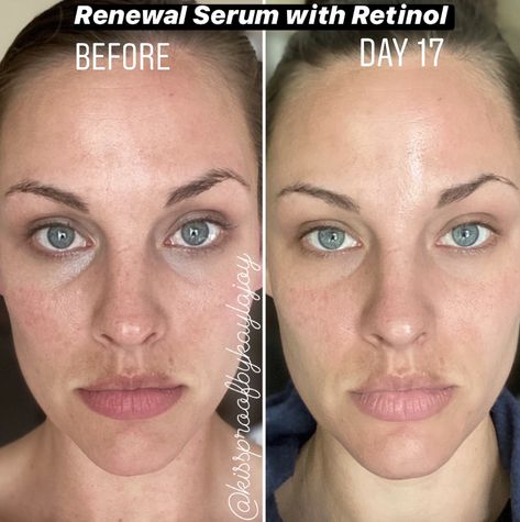 Retinol Guide, Tretinoin Before And After, Best Retinol Products, Make Pores Smaller, Healthy Skin Routine, Retinol Products, Roc Retinol Correxion, Best Retinol, Roc Retinol