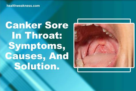 … Canker Sore In Throat: Symptoms, Causes, And Solution Read Post » Sore On Tongue Remedy, Canker Sore On Tongue, Sore Tongue, Canker Sore Causes, Tongue Sores, Vitamin C Supplement, Canker Sore, Cold Sore, Hormonal Changes