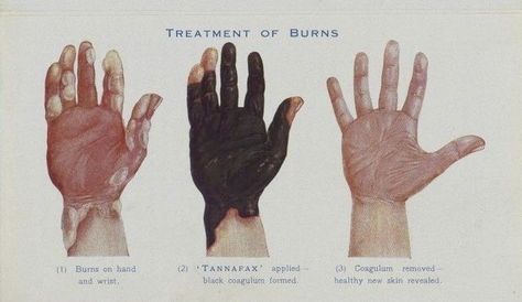 Burnt Skin Reference, Burn Marks Reference Drawing, Burns Reference, 얼굴 그리기, Arte Sketchbook, Anatomy Reference, Anatomy Art, Art Studies, Art Tips