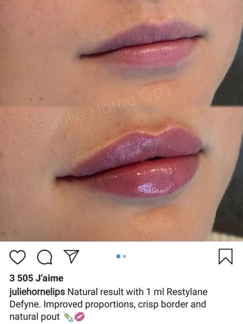 Lip Fillers Juvederm, Dermal Fillers Lips, Juvederm Lips, Lips Fillers, Lips Inspiration, Botox Lips, Facial Fillers, Lip Augmentation, Kiss Lips