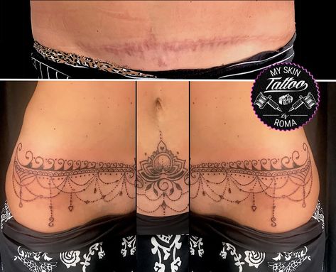 Tattoo Over Scar, Empire Tattoo, Scar Cover Up, Chain Tattoo, Medical Tattoo, Tattoos Simple, Street Tattoo, Scar Tattoo, Bug Tattoo