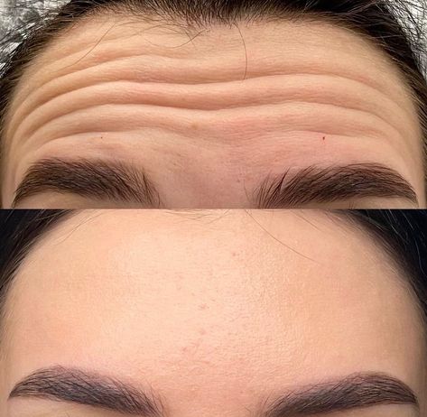 Botox works wonders 😍🔥 What a beautiful result 😍 Tired of having wrinkles and fine lines? No worries 😉  Just DM me or call for a Botox appointment ❤️ It won’t bother you anymore 💯 📲 (917) 701-0253  📞 (585)441-3838 #botoxnewyork #botoxinjections #botoxinjectionsnyc #botoxfacial #botoxtreatment #botoxtreatmentnyc #botox Armonizacion Facial, Botox Results, Botox Facial, Botox Injection, Botox Before And After, Facial Anatomy, Botox Face, Natural Toner, Wrinkle Serum