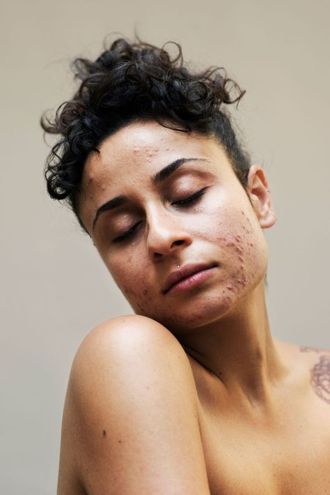 the #freethepimple movement wants you to embrace the skin you're in - i-D Body Positivity Photography, Human Photography, Body Photography, Be Confident, Beauty Standards, Real Beauty, New Skin, 인물 사진, Body Image