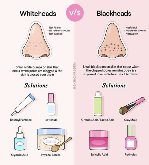 How to prevent black heads and whiteheads what are they what products to use to treat whitehead and black heads Things That Are Good For Your Skin, How To Get Rid Of Black Heads, Black Heads On Nose, How To Smile, Perfect Skincare Routine, Black Heads, Face Skin Care Routine, Skin Advice, Good Skin Tips