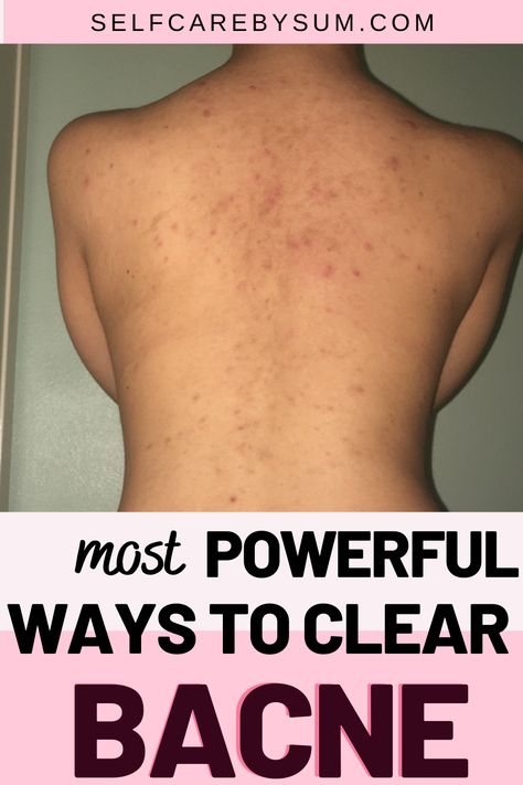 Get Rid Of Back Acne, Rid Of Back Acne, Back Acne Remedies, Blind Pimple, Pimples Under The Skin, Effaclar Duo, Back Acne, Bad Acne, Natural Acne Remedies