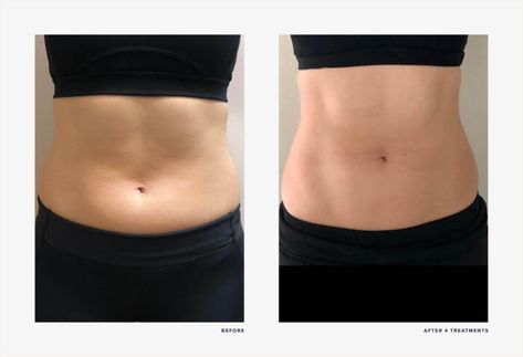 Em Sculpting Before And After, Emsculpt Neo Before And After, Emsculpt Before And After, Esthetic Marketing, Ems Sculpt, Stomach Pooch, Emsculpt Neo, Ad Ideas, Fitness Habits