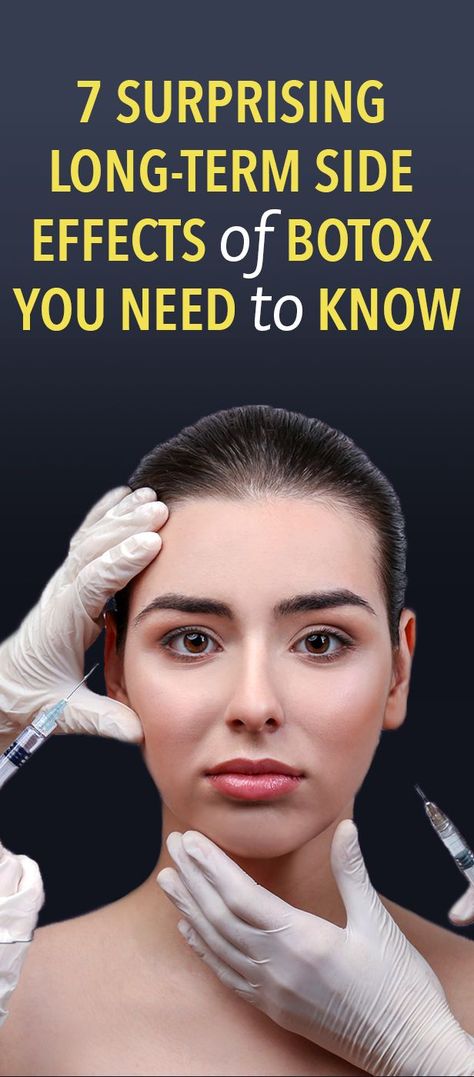 7 Surprising Long-Term Side Effects Of Botox You Need To Know Botox Forehead, Botox Results, Natural Botox, Botox Before And After, Vaseline Beauty Tips, Face Fillers, Korean Beauty Tips, Botox Face, Beauty Tips In Urdu