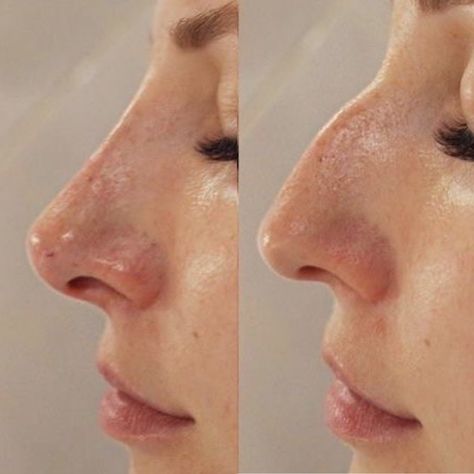 Rhinoplasty Before And After Front View, High Radix Nose, Nose Job Inspo, Nose Filler, Kylie Jenner Plastic Surgery, Jaw Reduction Surgery, Nose Surgery Rhinoplasty, Ethnic Rhinoplasty, Nose Fillers