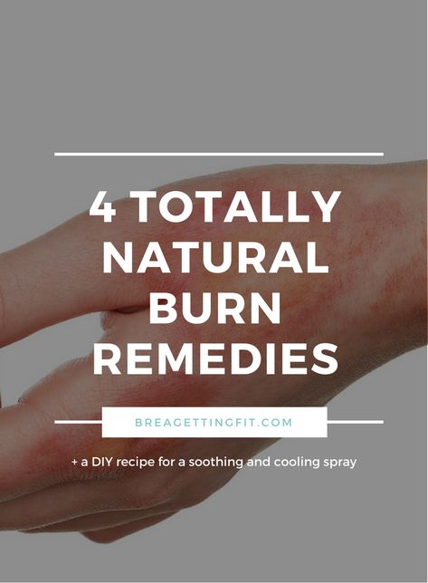 How To Heal A Burn Quickly, Burn Relief Skin, Burn Remedies, Curling Iron Burn, Burn Remedy, Burn Care, Burn Relief, How To Heal Burns, Treat Burns