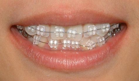 Porcelain Braces, Invisible Teeth Braces, White Braces, Kawat Gigi, Natural Teeth Whitening Diy, Zoom Teeth Whitening, Ceramic Braces, Braces Cost, Teeth Whitening Dentist