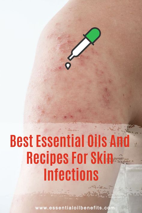 Oils For Infection On Skin, Antibacterial Essential Oils For Skin, Essential Oils For Infection On Skin, Essential Oils For Fungal Infections, Essential Oils For Rashes Skin, Essential Oils For Infection, Essential Oils For Rash, Yeast Infection On Skin, Skin Essential Oils