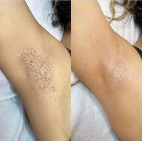 Female Waxing, Underarm Waxing, Esthetician Inspiration, Wax Photos, Underarm Odor, Hair Eraser, Underarm Hair Removal, Painless Hair Removal, At Home Hair Removal