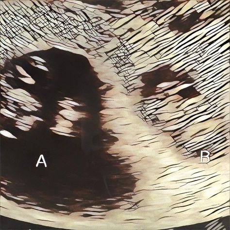 Vanishing Twin Syndrome: Causes, Signs and Effects Vanishing Twin Syndrome, Vanishing Twin, Ultrasound Reveal, Syndrome Quotes, Chromosomal Abnormalities, Amniotic Fluid, Obstetrics And Gynaecology, Pelvic Pain, How To Have Twins