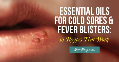 Essential Oils For Fever Blister, Fever Blister Essential Oils, Essential Oils For Blisters, Essential Oils For Cold Sores, Essential Oils For Fever, Fever Blister Remedy, Cold Sore Essential Oil, Blister Remedies, Cold Sore Lip