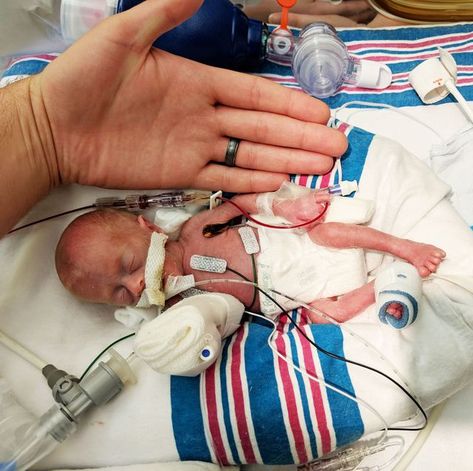 Medical procedure, Child, Baby, Birth, Childbirth, Patient, Hand, Preemie Babies Pictures, Injection Hand Pic, Discharged From Hospital, Premie Baby, Nursing School Motivation, Premature Birth, Preemie Baby, Micro Preemie