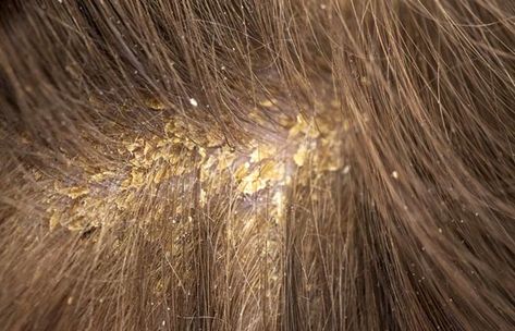 Different Types Of Dandruff And How To Stop Them Scalp Scabs, Scaly Scalp, Flakey Scalp, Dry Scalp Remedy, Dry Flaky Scalp, Dandruff Causes, Oils For Dandruff, Dandruff Flakes, Dandruff Remedy