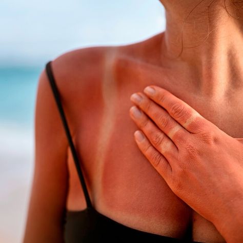 How to Soothe and Heal a Sunburn Quickly — Health Sunburn Aesthetic Face, Heal Sunburn, Sunburn Skin, Defense Mechanism, Post Inflammatory Hyperpigmentation, Prevent Ingrown Hairs, Treat Acne, Lip Hydration, Clogged Pores