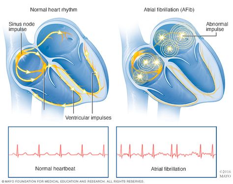 Atrial fibrillation Normal Heart, Congenital Heart, Atrial Fibrillation, Heart Rhythms, Coronary Arteries, Cardiovascular System, Mayo Clinic, Cardiology, Medical Education