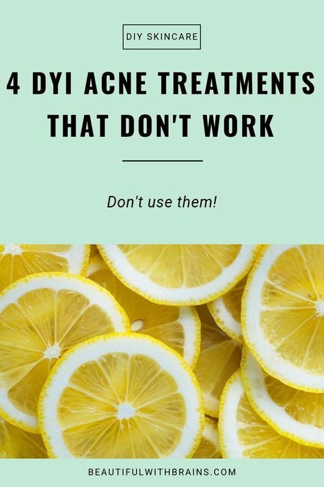 4 DIY acne treatments that don't work. Click this pin to find out what they are and why you shouldn't use them. #skincare #acne #diy #diyskincare #diybeauty Artery Cleanse, Forehead Acne, Back Acne, Bad Acne, Prevent Pimples, Diy Acne, Acne Treatments, Natural Acne Remedies, What To Use