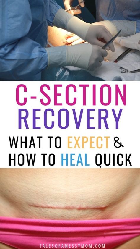 C-section recovery tips and what to put in your c-section recovery kit. The best postpartum recovery tips for what to expect and healing fast after a c-section. Cesarean section recovery cases and tips for mom. #csectionrecovery #postpartumrecovery #cesarean #csection #postpartum When To Workout, C Section Recovery Timeline, Healing From C Section, Mother Tips, C Section Scar, Cesarean Delivery, Postpartum Healing, C Section Scars, Emergency C Section