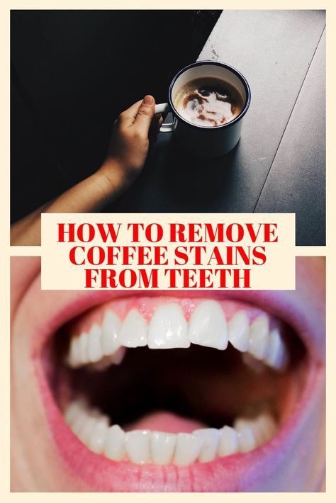 If you're wondering if Smile Brilliant really works, read all about my honest review here! I'm always aware of my stained teeth from coffee and this helped! #coffeestainedteeth #teethwhitener #beauty #teeth Remove Coffee Stains From Teeth, Teeth Stain Remover, Coffee Stain Removal, Teeth Logo, Dental Impressions, Loose Tooth, Tooth Removal, Perfect Teeth, Teeth Health