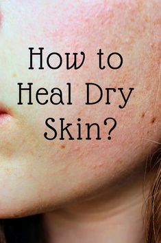 Tips to heal dry and itchy skin. Dry Skin Makeup, Brown Spots On Skin, Healing Dry Skin, Extremely Dry Skin, Dry Skin On Face, Dry Skin Remedies, Combination Skin Type, Skin Spots, Spots On Face